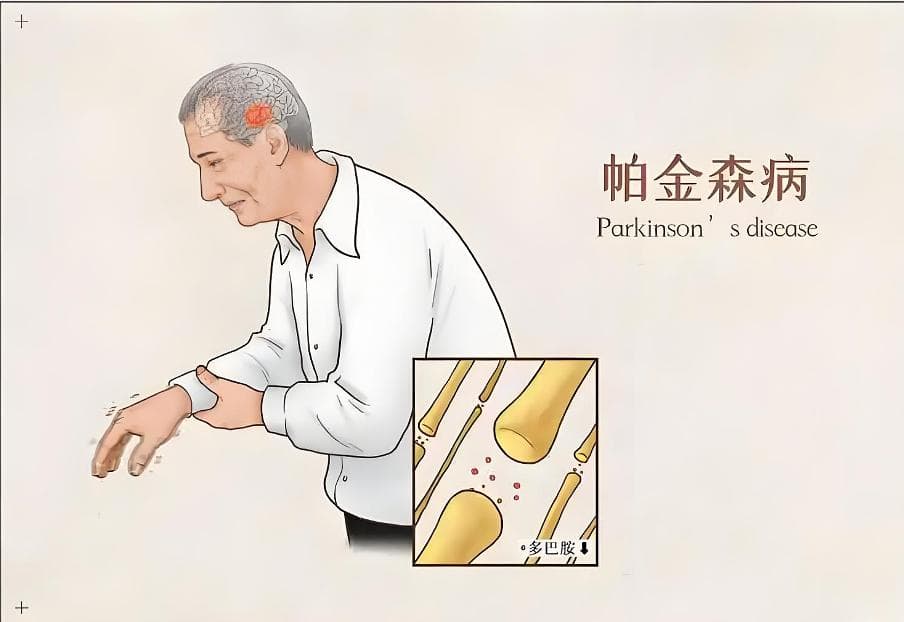如何帮助帕金森病患者改善生活质量？