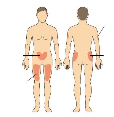 【世界防治糖尿病日】“针”爱有加：胰岛素注射规范全知道