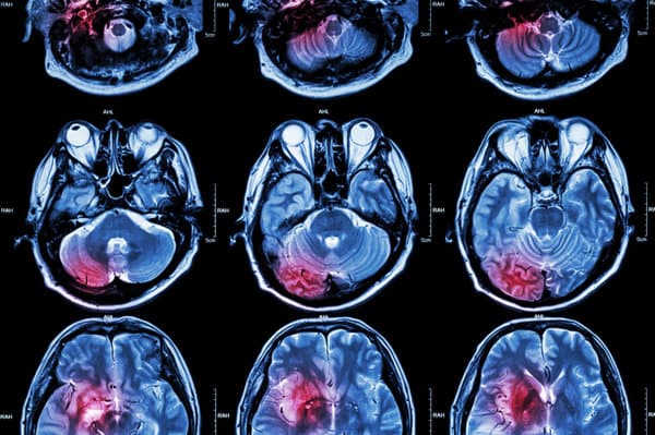 腔隙性脑梗死的影像学诊断：为什么需要MRI检查？