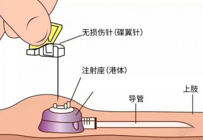 肿瘤治疗中的输液港：正确维护与使用指南