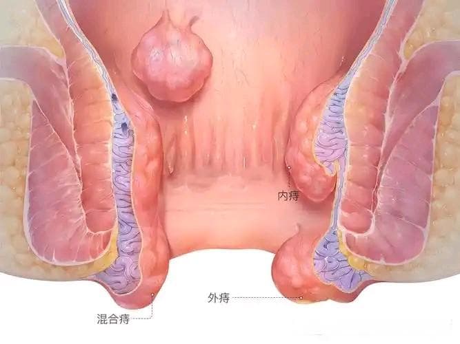 哪些生活习惯容易得痔疮？快看您中招了没？