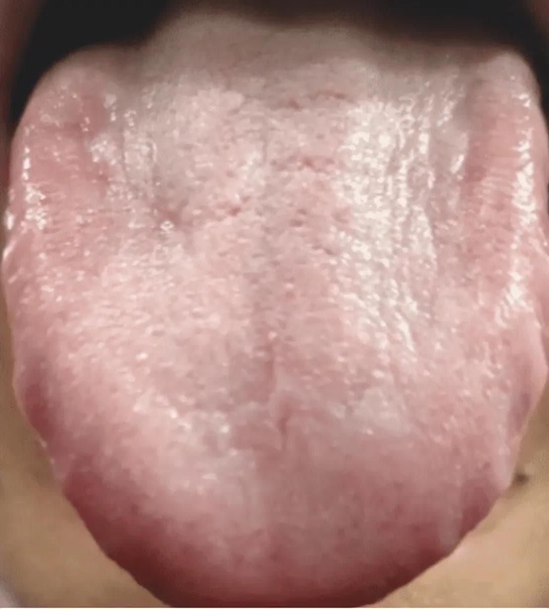 脾胃一虚百病来！脾胃最怕的4种舌象，每个人都应该知道