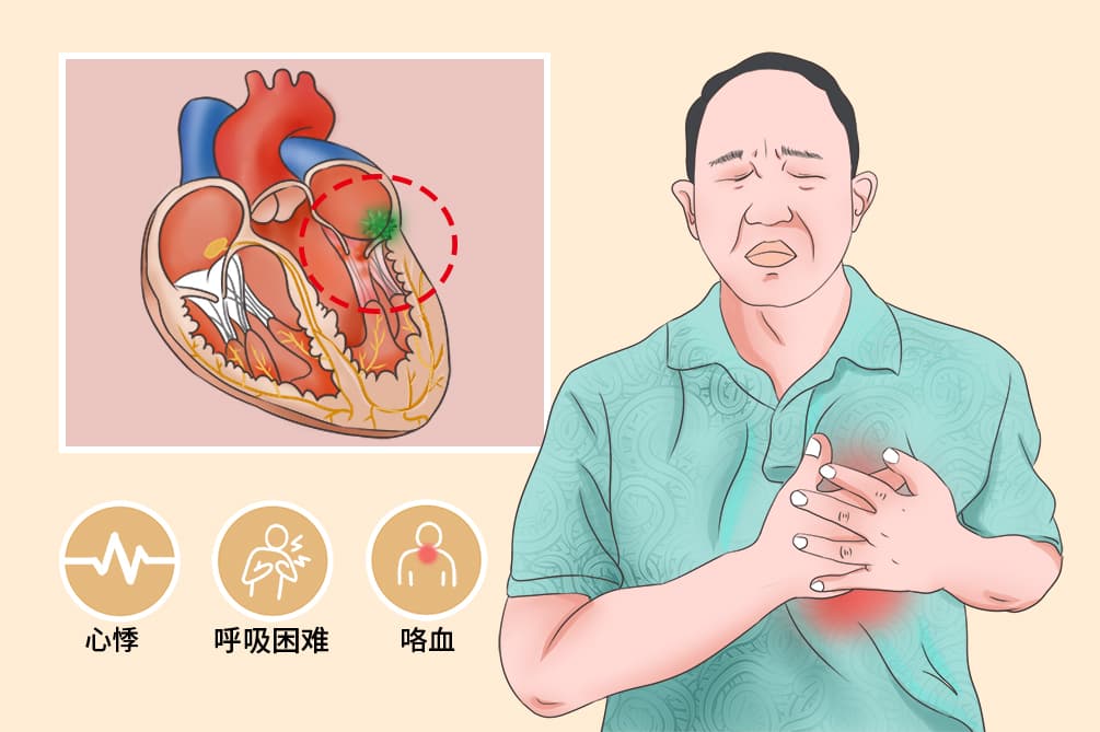 风湿性心脏病的症状和体征