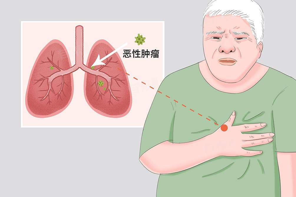 肺移植手术全解析：条件、费用与术后管理
