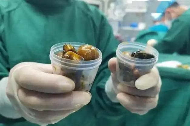 人有没有胆结石，看身体就明白？胆内有结石，身体或现这3种状况