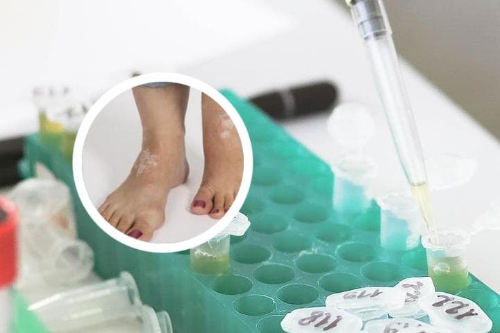 白癜风健康管理规划