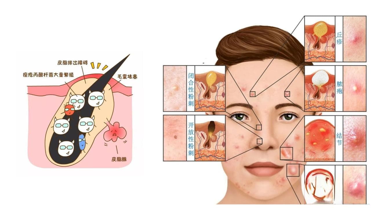 科学战“痘”：从发病到预防，一文读懂痤疮全攻略