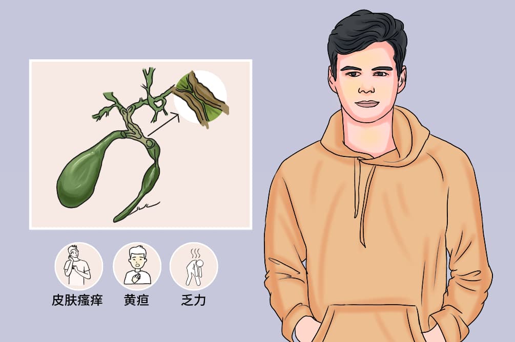 原发性硬化性胆管炎