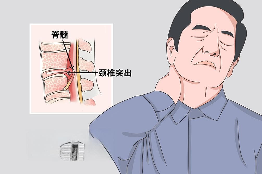 颈椎病的治疗方法全解析
