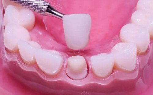 牙缝越来越大？原因、危害及修复方法全解析