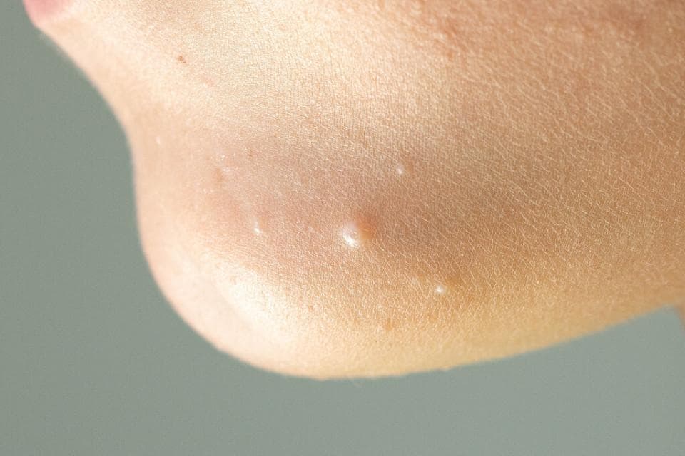这些夏天易冒的“小疙瘩”，该怎么处理？一文说清楚