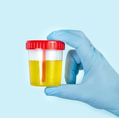 尿胆原、尿胆红素阳性的临床意义