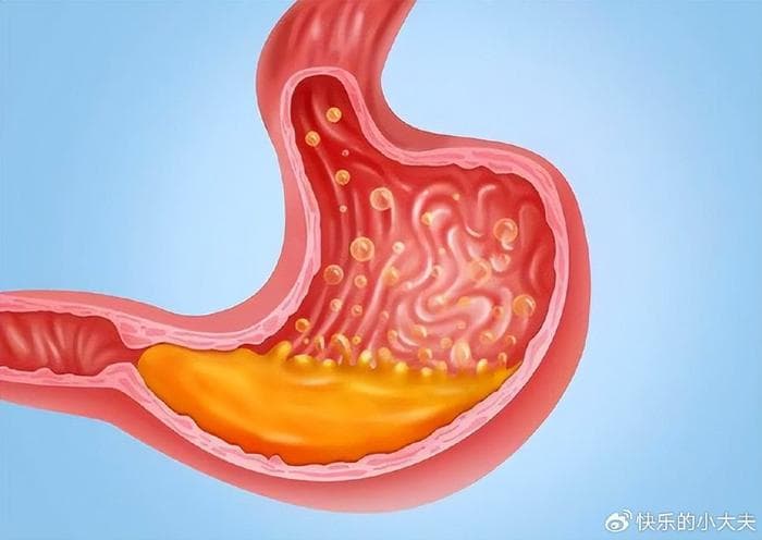 突发胃痛、恶心、呕吐，小心胃穿孔，立即拨打120，4类因素易患病