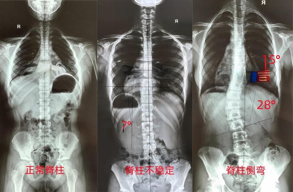 肩膀一高一低，就是脊柱侧弯吗？