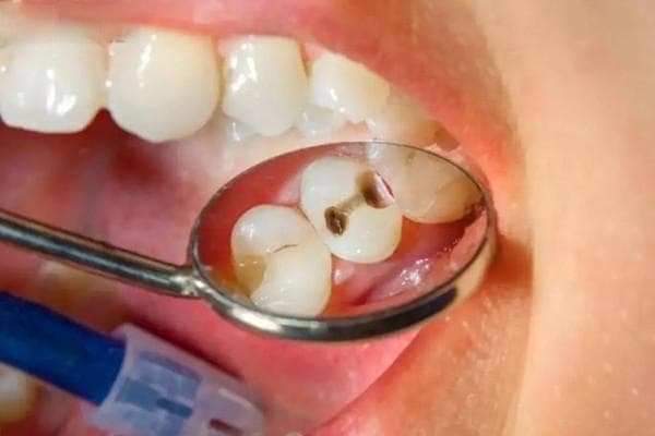 如何判断蛀牙有没有伤到牙髓？蛀牙的原因、症状及治疗方法须知