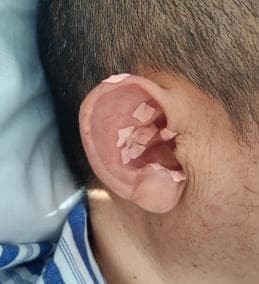 中医护理妙招助力肠造口患者术后康复