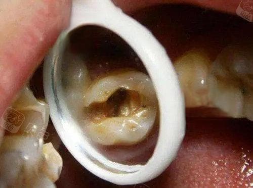 智齿有蛀牙洞是补还是拔?一般建议拔掉为佳!正常生长的智齿龋坏成大窟窿了还好拔吗?