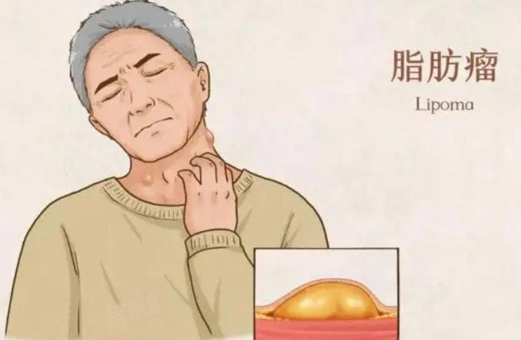 脂肪瘤看哪个科