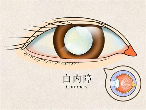 白内障手术什么情况下不能做，有这五种情况的人不能做白内障手术！