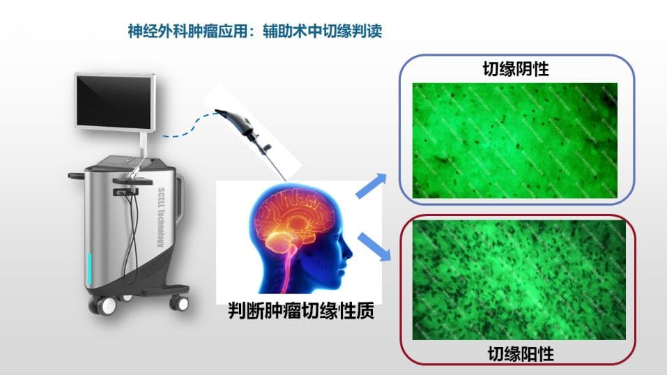 【临床创新】神经外科首次应用术中手持细胞显微镜完成术中颅内疑难肿瘤诊断手术