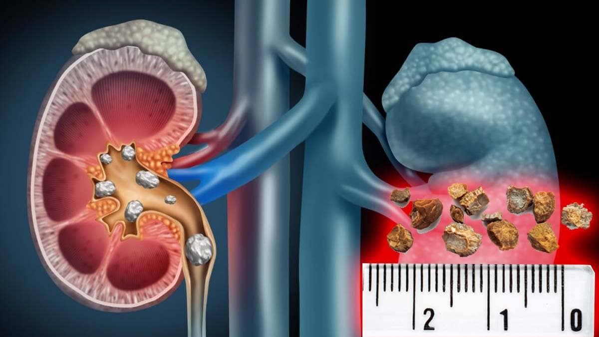 缓解肾结石疼痛的7种方法