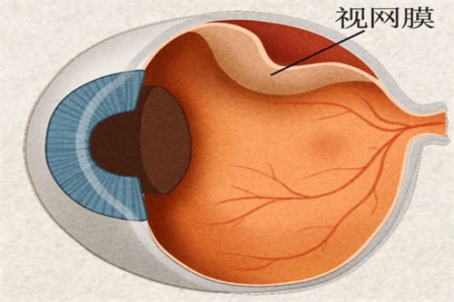视网膜为什么会反复脱落？很可怕吗