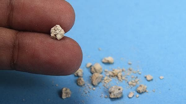 肝内管结石的治疗方法