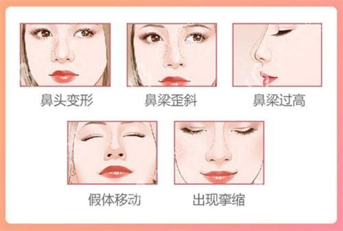 鼻子天生歪斜能矫正吗？鼻中隔矫正可挽救，深入解析其手术原理