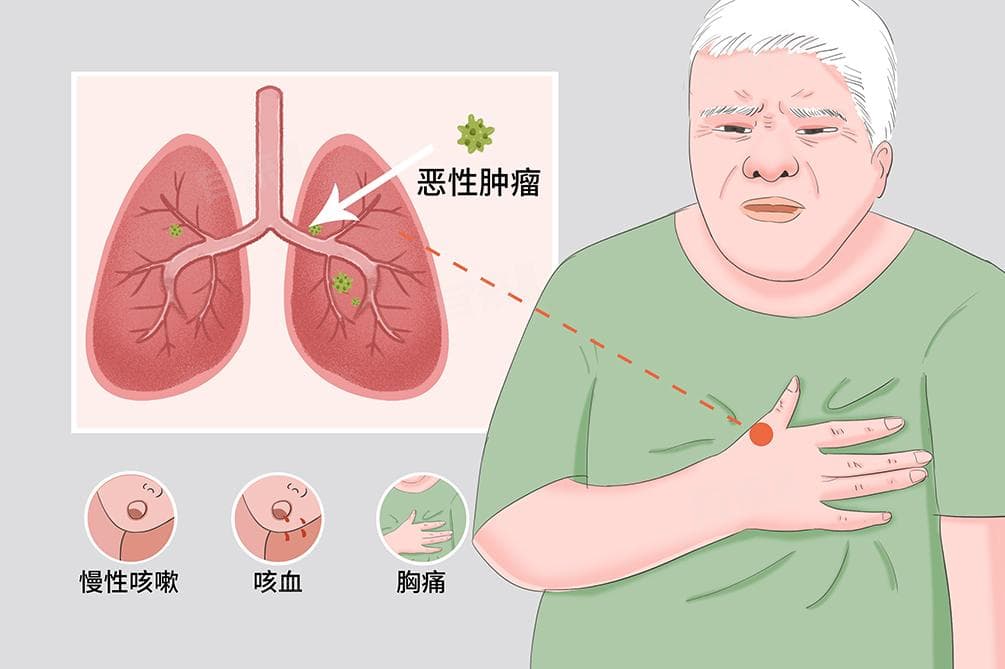一般肺癌咳血几天一次