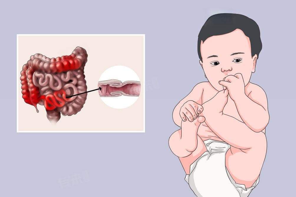 什么是肠套叠？症状、原因及治疗方法全解析