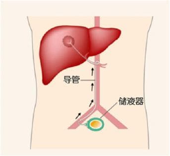 肝动脉灌注化疗（HAIC）：原理、优势与适用人群详解