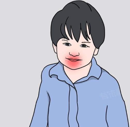 手足口病的症状及治疗措施