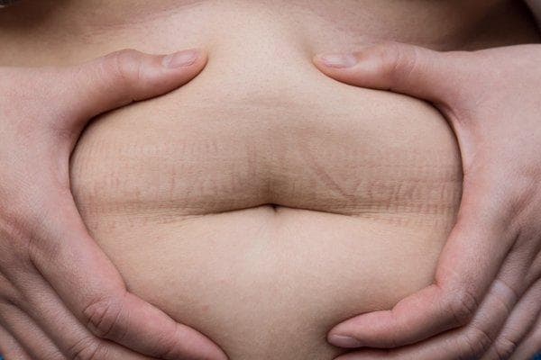 腹直肌分离怎么恢复？5种科学方法助你重获平坦小腹
