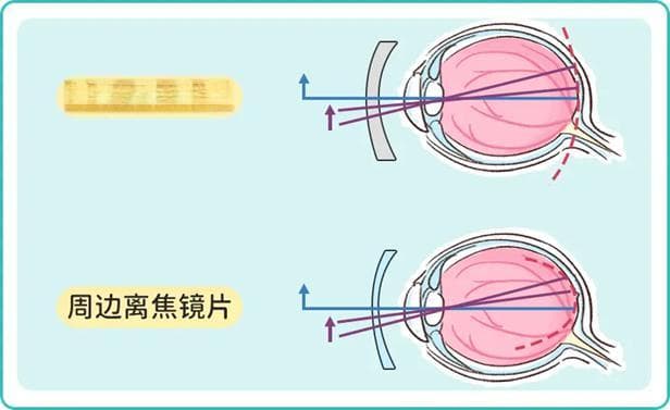 医生，离焦眼镜到底是不是智商税啊？