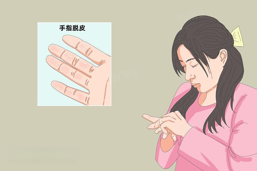 手指脱皮最佳治疗方法
