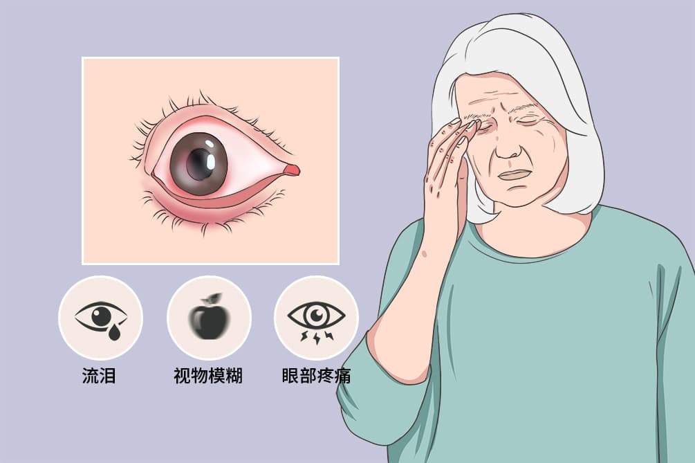 病毒性角膜炎：病因、症状、诊断与治疗全解析