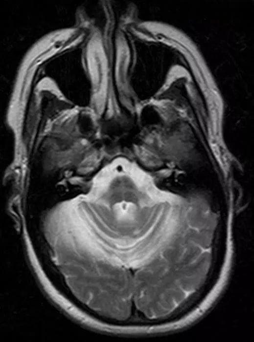 重新认识脑桥MRI“十字征”（hot cross bun sign）
