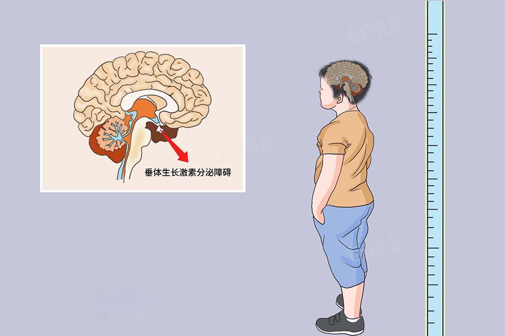 矮小症是怎样引起的