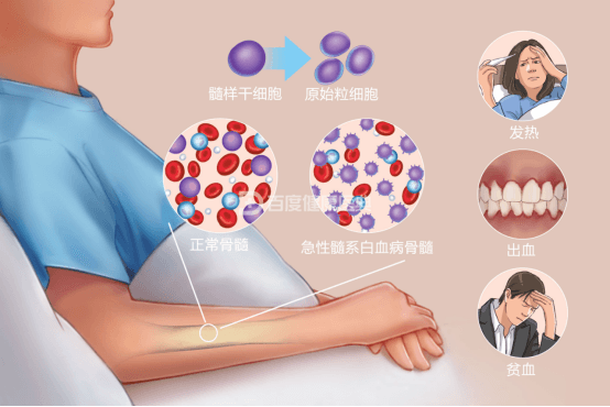孩子身上出现这几个信号需警惕白血病