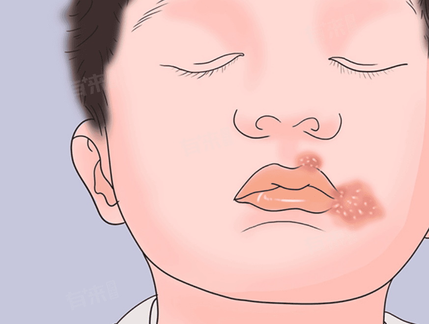 口角烂是什么病？一文详解口角炎的成因与治疗