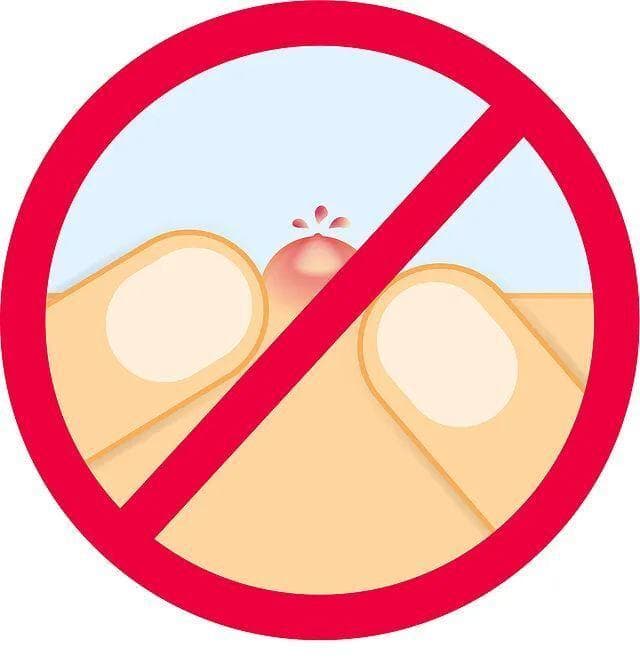 严重可致细菌感染 一文告诉你哪些痘痘不能乱挤
