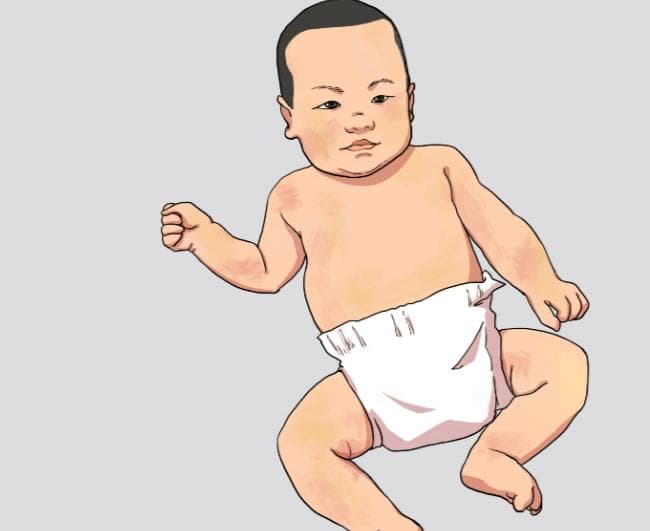 小孩黄疸高怎么办？四种常见原因及治疗方法详解