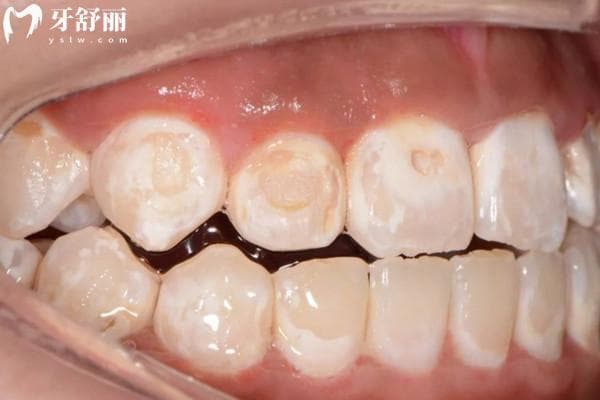 龋齿矿化怎么治疗？需要特定的治疗方式来促进复原哦