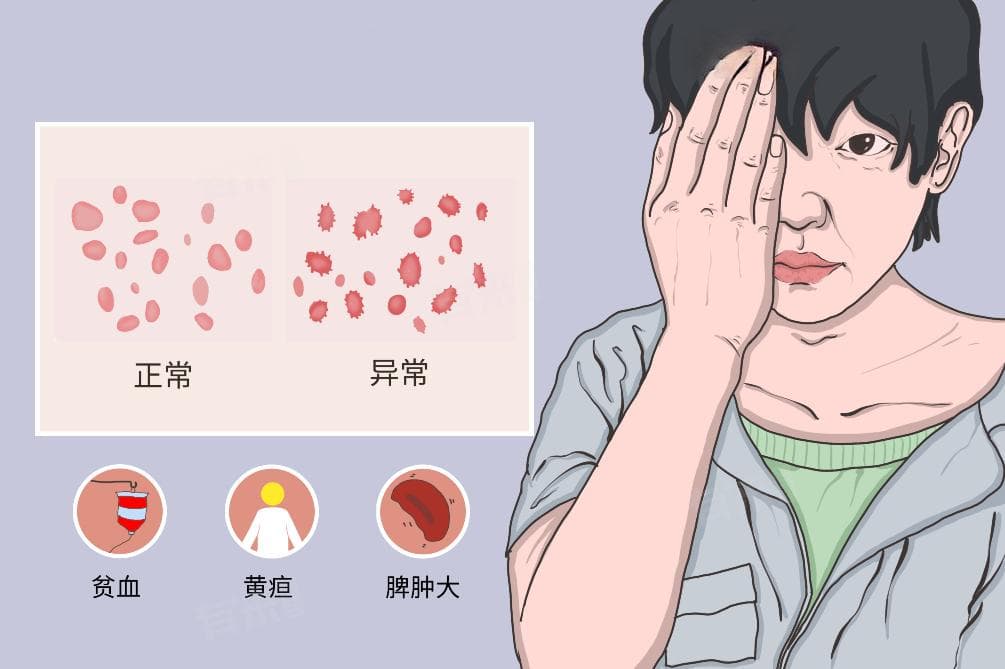 溶血性贫血诊断标准