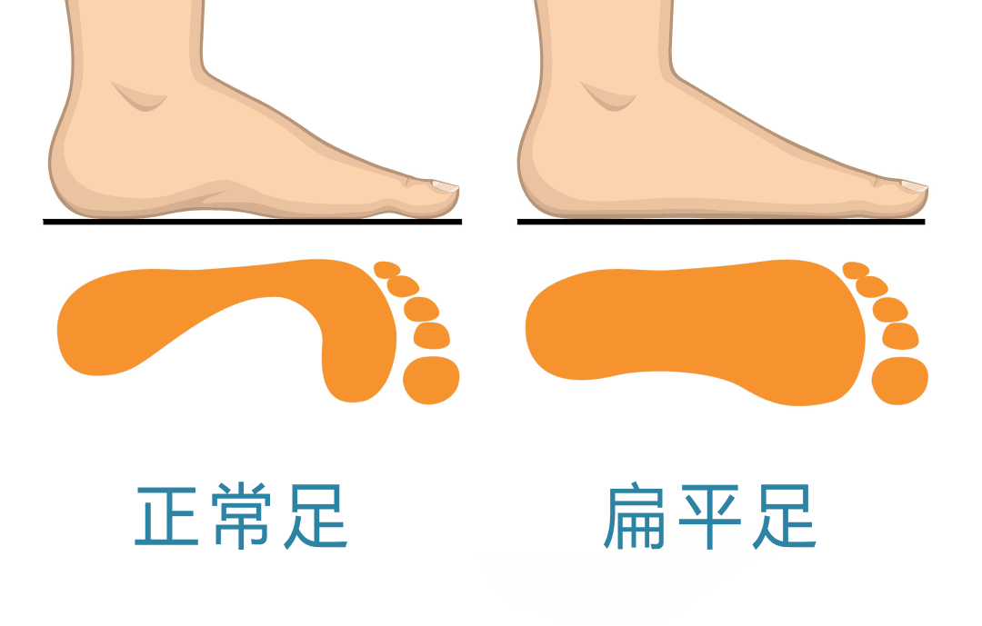 人到中年，看看足弓塌了没？全身姿态都可能受到影响……