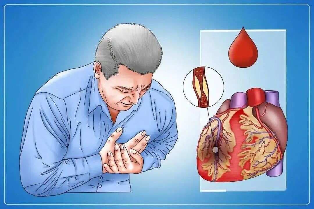 心肌酶谱是什么？又有何临床意义？
