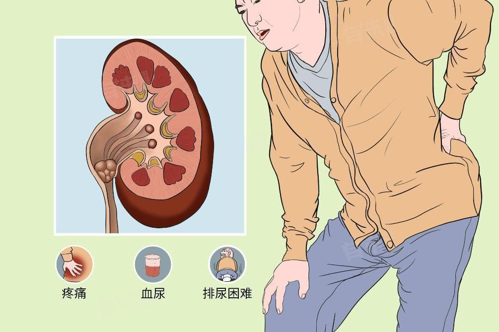 肾结石不管它会造成什么后果
