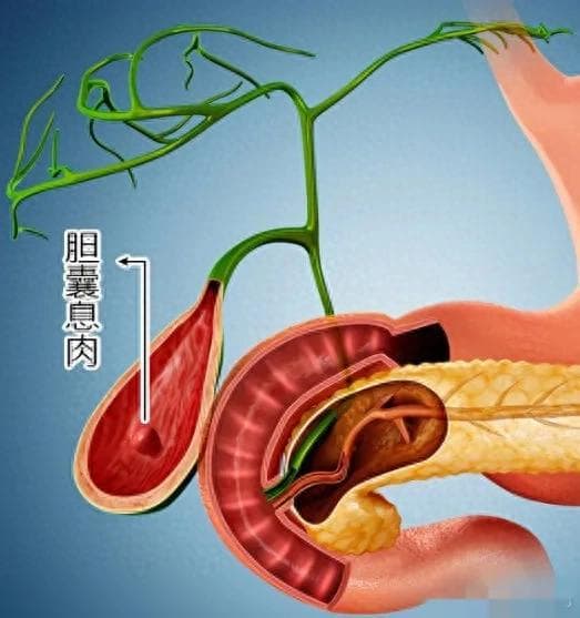 胆囊息肉的3个调理方法