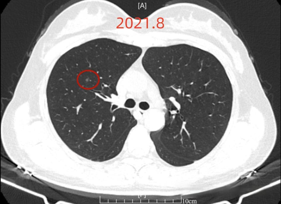 肺结节随访案例分析：从发现到治疗的专业建议