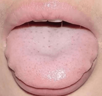 九种体质 舌象分析 调理方法，值得收藏